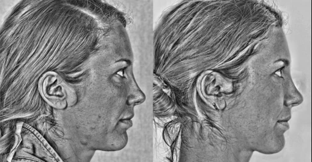 Federica - improvement in the skin with the black and white filter