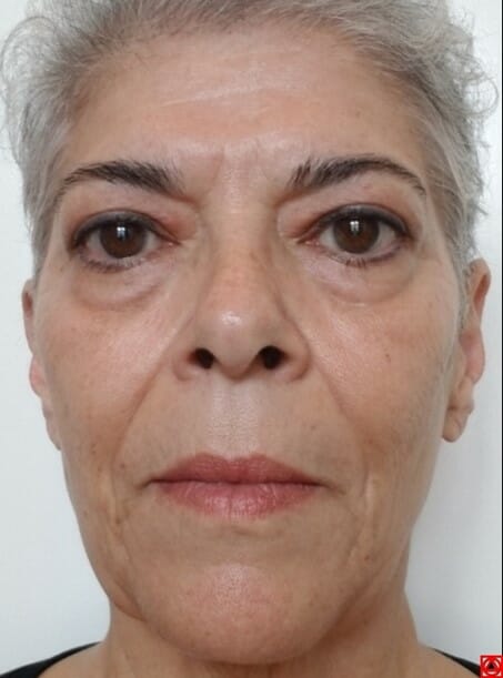 Natural facelift is already starting to work in 2 months
