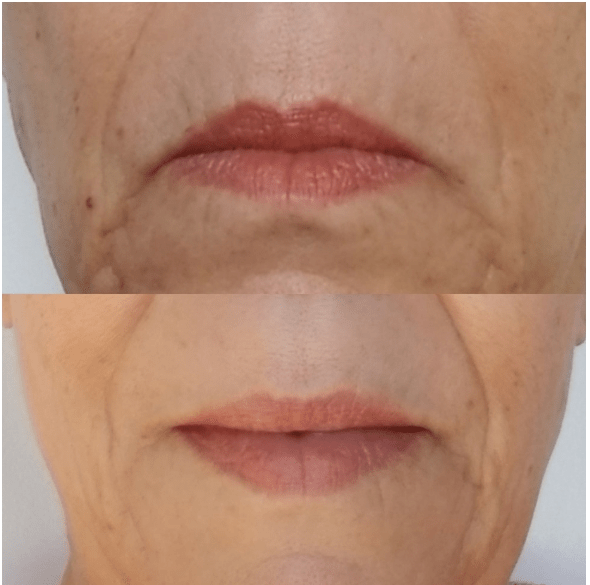 How to get fuller lips naturally?