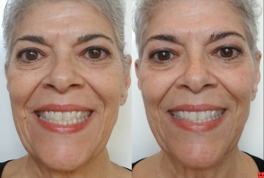 Natural smile makeover at a fraction of the cost